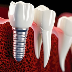 a digital graphic showing a dental implant fused with the jawbone
