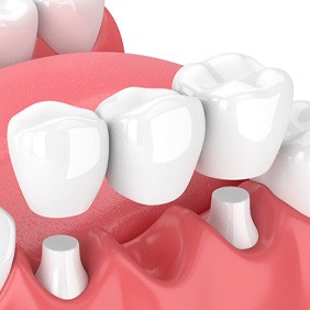 illustration traditional dental bridge in New York