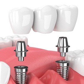 illustration implant dental bridge in New York