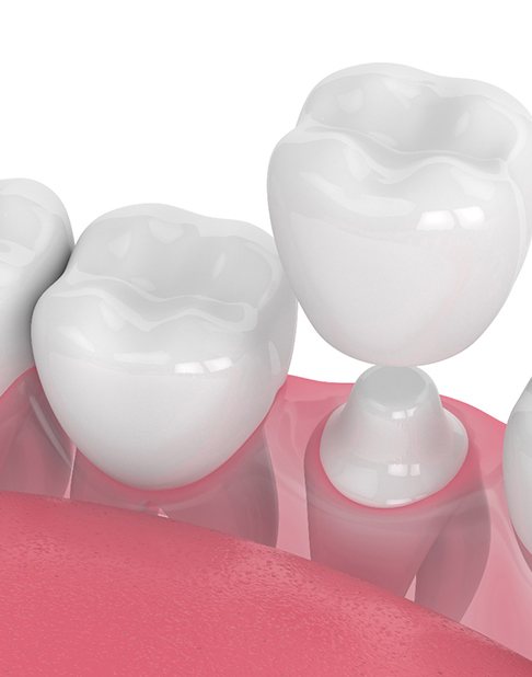 3D illustration Dental crowns in New York 
