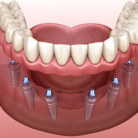 an illustration of implant dentures in New York 