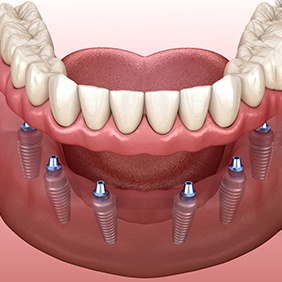an illustration of implant dentures in New York