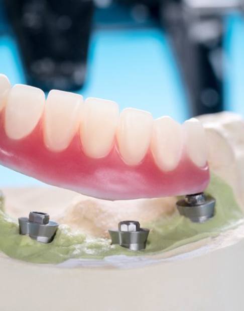 WHAT ARE IMP DENTURES
A denture resting on a plastic model that clearly shows dental implants underneath