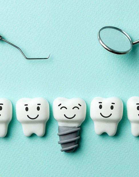 Illustration of dental implant