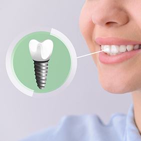 a 3D illustration of a dental implant