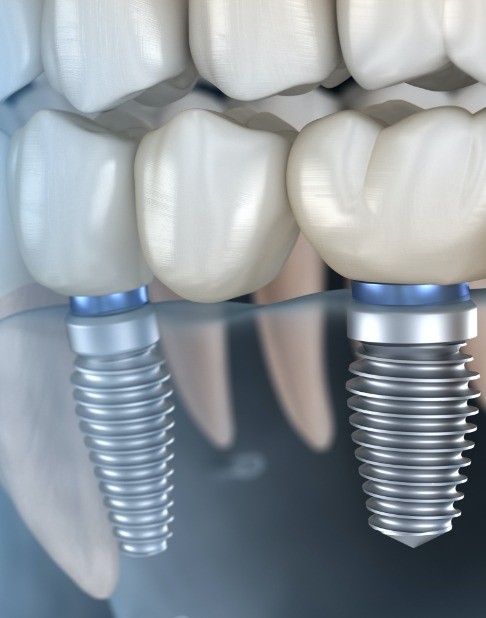 Animated smile with dental implant supported fixed bridge