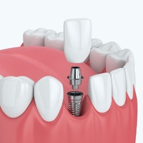 Animated smile during dental implant supported dental crown placement