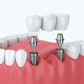 Animated smile during dental implant supported fixed bridge placement