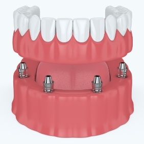 Animated smile during dental implant supported denture placement