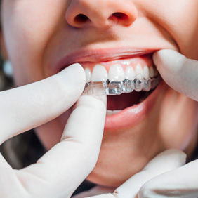 Female patient having Invisalign placed on upper teeth