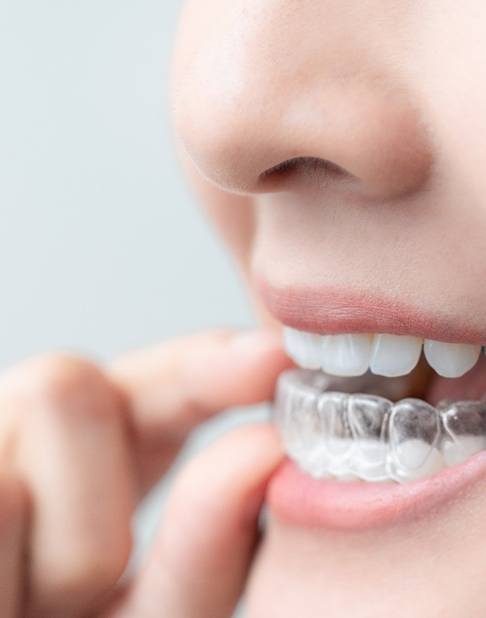 Nose-to-chin profile view of someone removing their Invisalign from their lower teeth