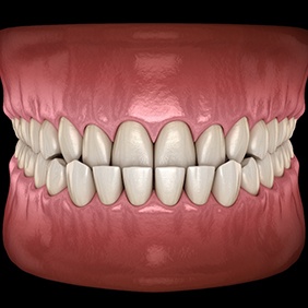 Rendering of a profile view of an upper arch overextending beyond the lower one