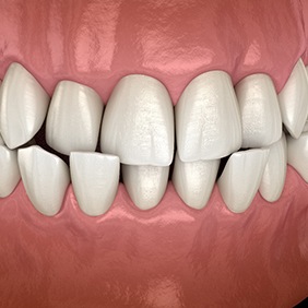 Rendering of a frontal view of an underbite