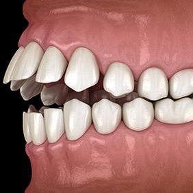 Rendering of a frontal view of a crossbite