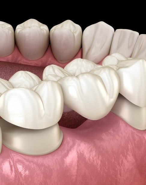 Animated smile during dental bridge placement