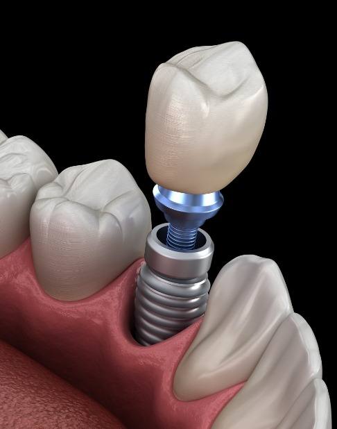 Animated smile during dental implant supported dental crown placement