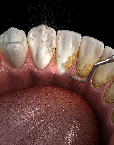 Animated smile during scaling and root planing gum disease treatment