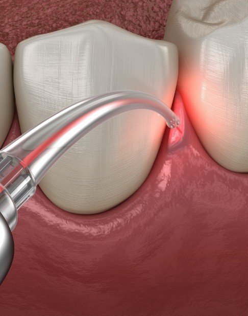 Animated smile during laser dentistry treatment