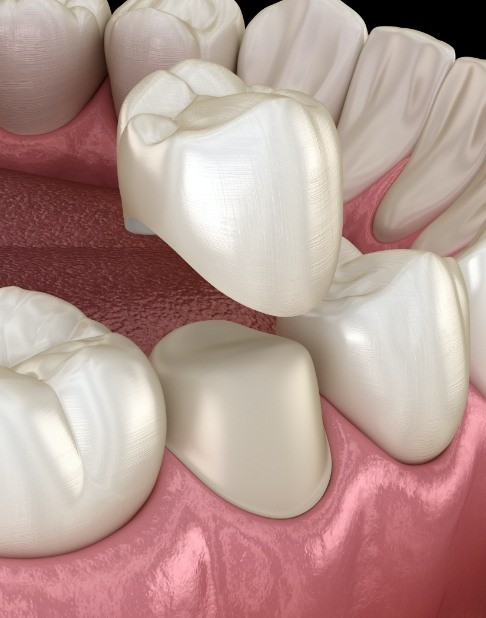 Animated smile during dental crown restorative dentistry placement