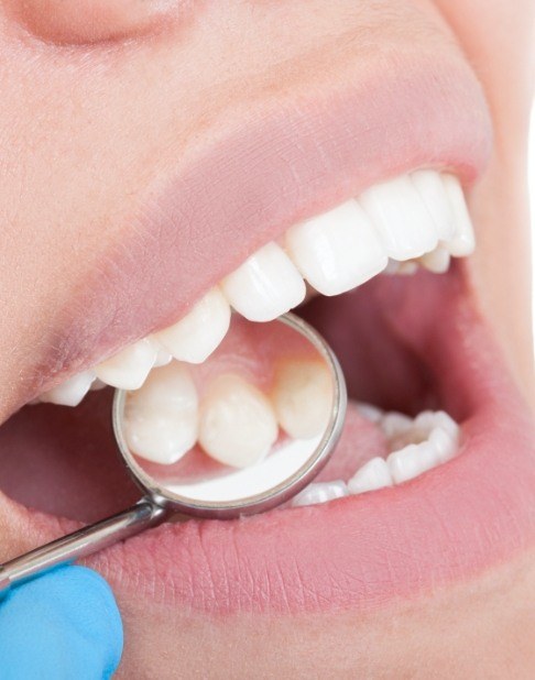 Dentist examining smile after tooth colored filling treatment