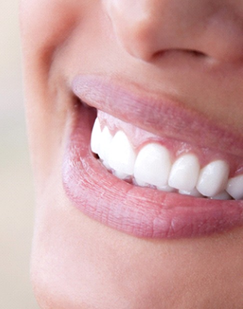 woman smiling after getting veneers in New York