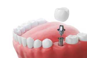 CGI illustration of a row of teeth with a dental implant being inserted in pieces